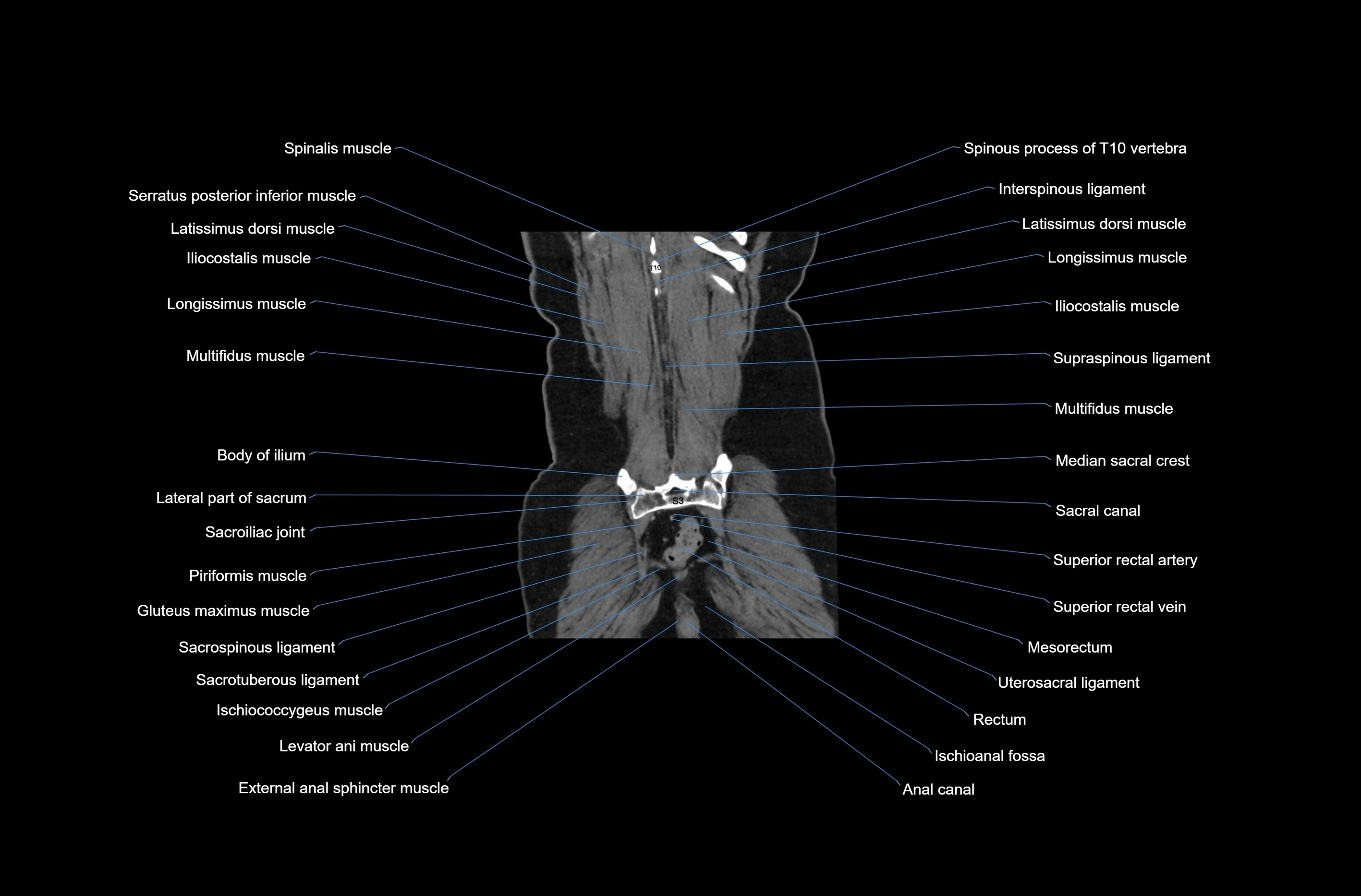 CT abdomen coronal cross sectional anatomy labelled radiology image-00075.webp